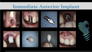 Immediate Anterior Implant  Temp Crown Fabrication  Step by Step [upl. by Crandall227]