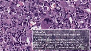 Pleomorphic Rhabdomyosarcoma [upl. by Nancee]