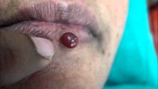 Hemangioma Lower Lip [upl. by Romney882]