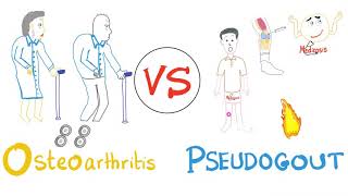 Pseudogout VS Osteoarthritis  Rheumatology Series [upl. by Ecnerwal225]