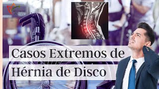 Hérnia de Disco Pode Causar Tetraplegia Em Um Caso Extremo [upl. by Brandais]