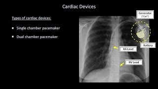 How to Interpret a Chest XRay Lesson 9  Atelectasis Lines Tubes Devices and Surgeries [upl. by Canale656]