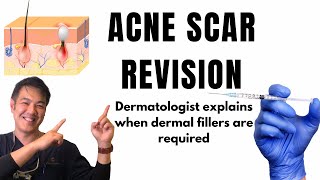 How to treat ACNE SCARS  Dermal Fillers [upl. by Devy]