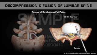 Decompression amp Fusion of Lumbar Spine [upl. by Hannah]