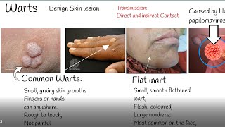 Warts causes and treatment Wart Types [upl. by Nuhsed]