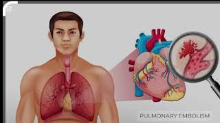 pulmonary embolism [upl. by Vacuva425]