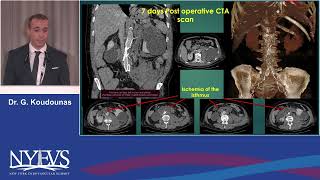 Endovascular management of a ruptured abdominal aortic aneurysm in a Covid 19 patient with a horsesh [upl. by Intirb]