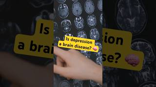 Is Depression a Brain Disease [upl. by Nahgeem]