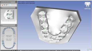 Dental Model Analyses in Planmeca Romexis® 3D Ortho Studio [upl. by Eleira]