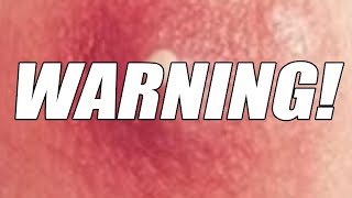 Warning Abscess Removal NSFE [upl. by Freberg515]