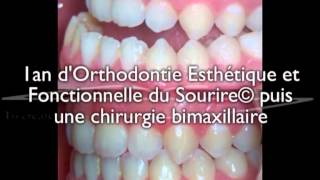 Chirurgie bimaxillaire pour un jeune adulte  correction avec 1an daligneurs® en OEFS© [upl. by Gemini]