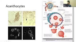 APPROACH TO NEPHRITIC AND NEPHROTIC SYNDROMES  DR JAYAPRAKASH THANGAVEL NEPHROLOGY [upl. by Denison]