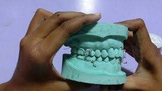 ivy loop eyelet wiring for intermaxillary fixation on dental model [upl. by Juno]