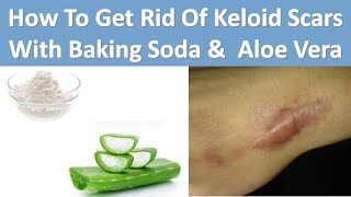 How To Get Rid Of Keloid Scars With Baking Soda amp Aloe Vera [upl. by Nelluc4]