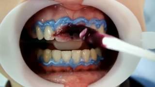 Using FGM Whiteness HP Maxx For In Office Bleaching Tooth Whitening [upl. by Varney]