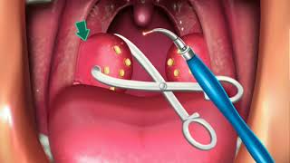 Animation Surgery of Tonsillectomy amp Adenoids [upl. by Eboh]