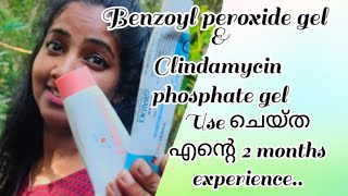 Benzoyl peroxide gelHow to get pimple free faceremove pimples [upl. by Zeret552]