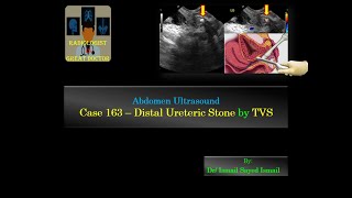 Ultrasound Case 163  Distal Ureteric Stone seen Only by TVS [upl. by Ainevul]