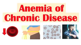 Anemia of Chronic Disease  Causes Pathophysiology Signs amp Symptoms Diagnosis Treatment [upl. by Eet]