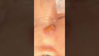 Basal cell carcinoma Local flap surgery skincancer carcinoma dermatology skincancersurgery [upl. by Schroder]