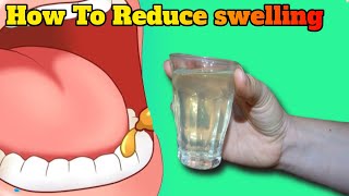 How To Reduce swelling of gums wisdom tooth with home remedies [upl. by Nileve116]