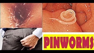 Pinworm पिनवॉर्म सम्पूर्ण जानकारी और बचाव के तरीके [upl. by Petras516]