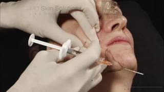 Combined therapies for treating the aging face with Pluryal hyaluronic acid filler [upl. by Taber320]