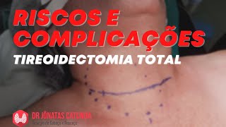 Tireoidectomia total é uma cirurgia perigosa Riscos e complicações [upl. by Nedyrb]