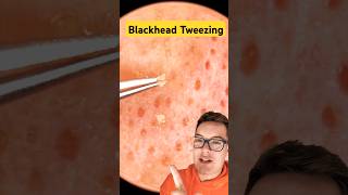 Crazy Satisfying BLACKHEAD TWEEZING  Sebaceous Filament Removal shorts [upl. by Naerb496]