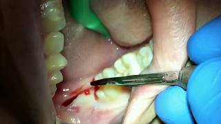 Step by Step extraction of impacted wisdom tooth  lower right third molar [upl. by Anilorak535]