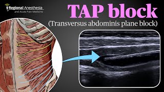 Ultrasound Guided Transversus Abdominis Plane TAP Block [upl. by Lemak]