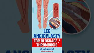 Opening Blocked arteries of Legs with Balloon Angioplasty youtubeshort legAngioplasty shortsfeed [upl. by Akinat]