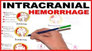 Intracranial Hemorrhage EpiduralSubduralSubarachnoid overview [upl. by Cadman320]