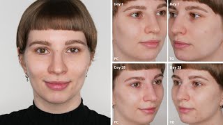 The Ordinary and Paulas Choice Azelaic Acid 10  4 Weeks Before and After Pictures  Split Face [upl. by Erdnoed]