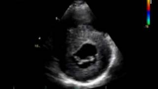 HOCM  CARDIOMYOPATHY HYPERTROPHIC echocardiography [upl. by Brandt390]