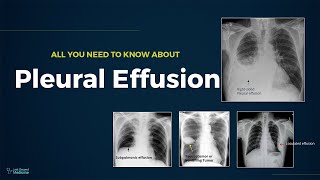 Transudate vs Exudate  Types of effusion  lights criteria [upl. by Fahey198]