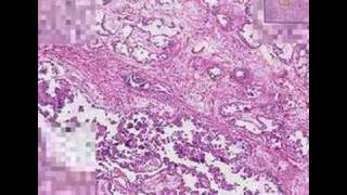 Histopathology TestisEmbryonal carcinoma [upl. by Idnim]