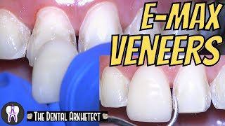 EMAX Porcelain Veneer HOW Do they DO it C41 4k [upl. by Lachus706]