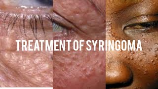 Treatment of syringoma [upl. by Etra]