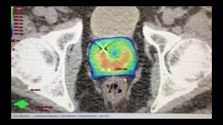 5Session Radiation Treatment For Prostate Cancer SBRT or Stereotactic Body Radiation Therapy [upl. by Acinorehs]