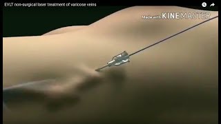 EVLT Laser Treatment for Varicose Veins The Future of Varicose Vein Treatment Animation Video [upl. by Leonteen979]