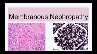 Membranous nephropathy [upl. by Eran]