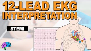 Recognize ST Elevation Myocardial Infarction STEMI on 12lead EKG [upl. by Atinel]