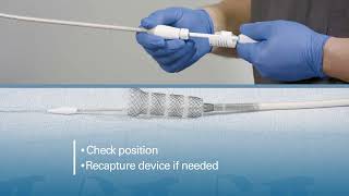 Esophageal Stent Tutorial [upl. by Hearn]