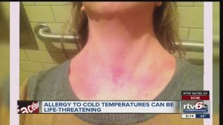 Noblesville woman suffers from rare allergy to cold weather [upl. by Grider625]