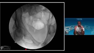 Pelvic trauma Part 2 The EUA and assessment of stability by Jai Rawal [upl. by Auqinom]