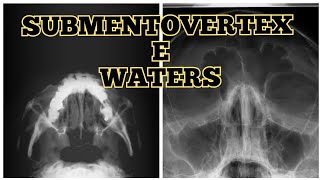 POSICIONAMENTOS DE WATERS E SUBMENTOVERTEX [upl. by Longo]