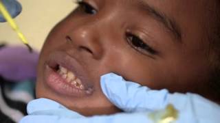 Provider Training Fluoride Varnish HD [upl. by Crary]