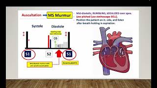 Mitral stenosis  Omar Layth  Cardiology made easy [upl. by Xaviera]