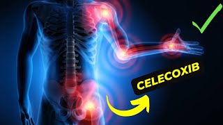 Celecoxib vs Other NSAIDs Which Is Better for Arthritis Pain Relief [upl. by Aivatnuhs]